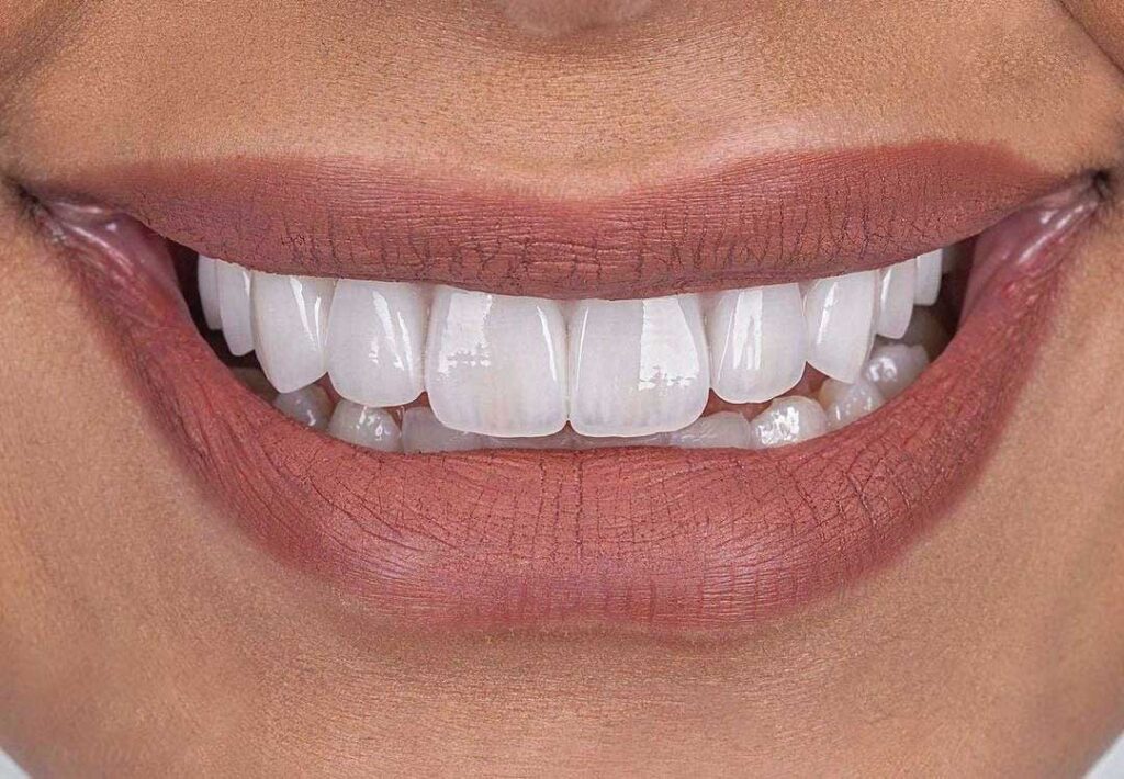 An example of working with the Veneers program Dynamica