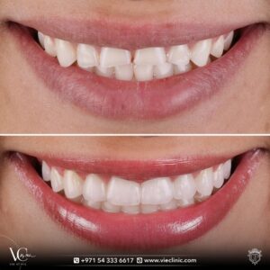 Dental veneers case before and after