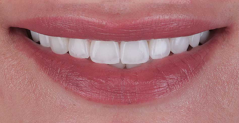 An example of working with the Veneers program