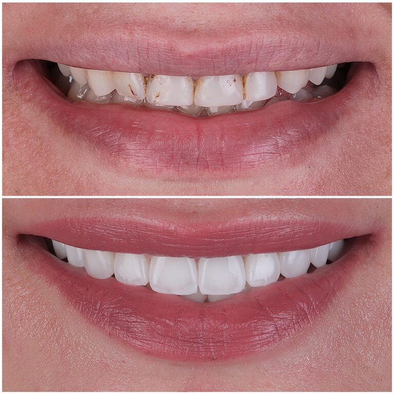 Dental veneers case before and after